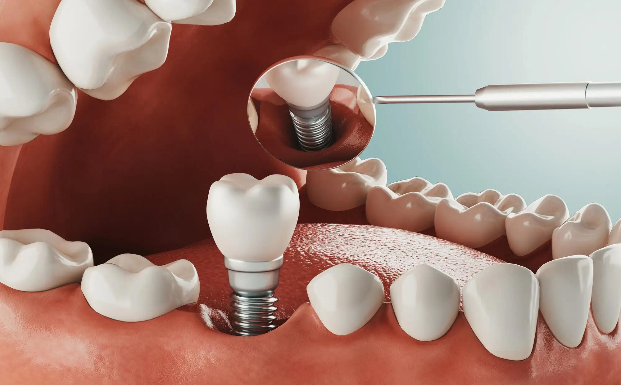 Advanced Dental Implants - Smirk Dental